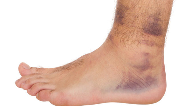 Dry Patch Of Skin On Ankle Bone